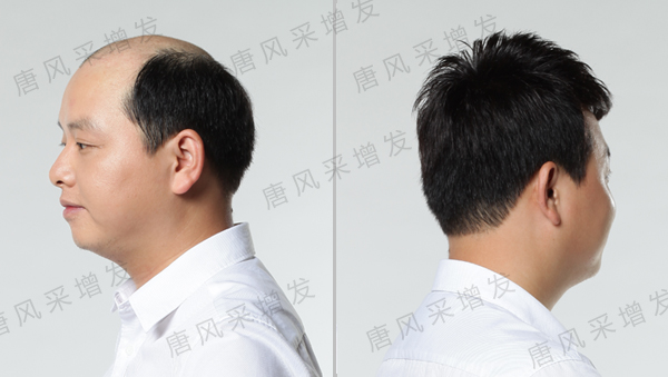 掉頭發(fā)禿頂怎么辦？45歲大叔容貌似90后！