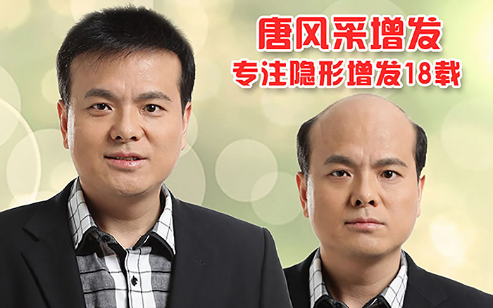 脂溢性脫發(fā)能治好嗎？專業(yè)機(jī)構(gòu)為你解答發(fā)體癥狀