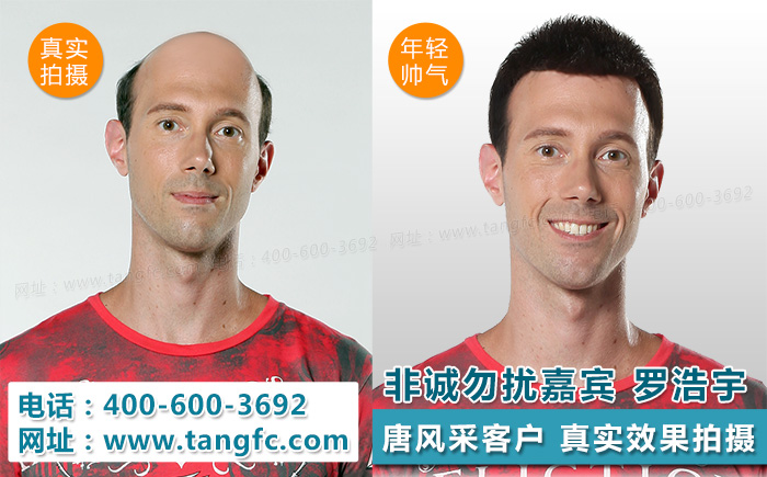 揭密掉發(fā)嚴(yán)重怎么辦？看這里