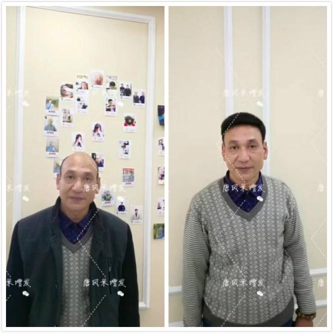 頭發(fā)少怎么辦？