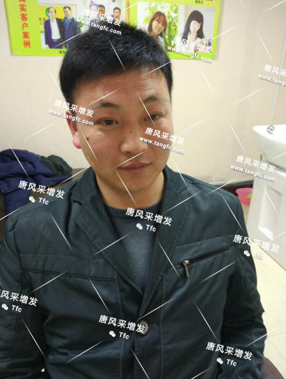 人民公仆也脫發(fā)，廈門夏先生增發(fā)記
