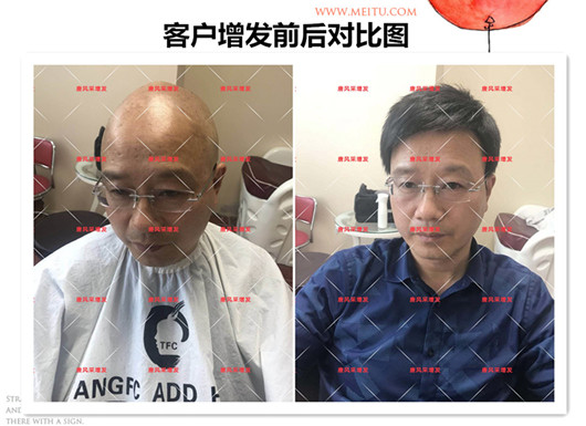 雙節(jié)同慶，給脫發(fā)的父親什么禮物，讓父親“年輕10歲”的神
