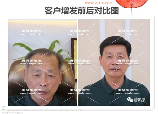 雙節(jié)同慶，給脫發(fā)的父親什么禮物，讓父親“年輕10歲”的神