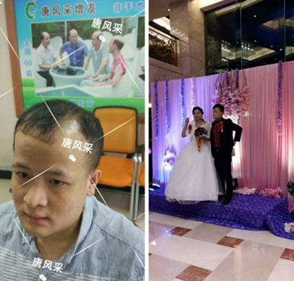我還沒有脫單，怎么就脫發(fā)了呢?