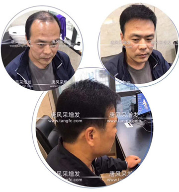 脫發(fā)如何補發(fā)效果真實，去哪里補發(fā)比較好！