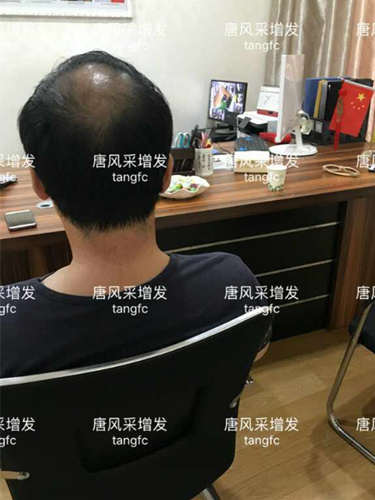 中年禿頂危機(jī) 脫發(fā)前