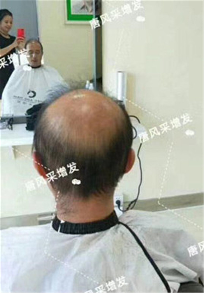 脂溢性脫發(fā) 官方二維碼 脫發(fā)
