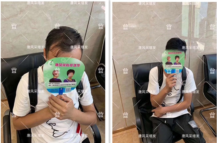 謝頂中年男 唐風(fēng)采增發(fā)后對比圖客戶
