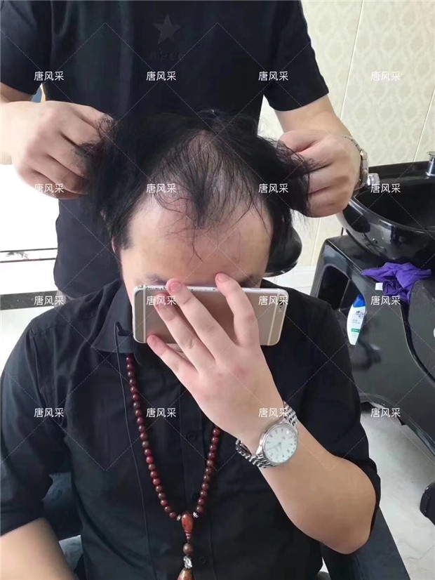 頭頂假發(fā)片 唐風(fēng)采真實案例