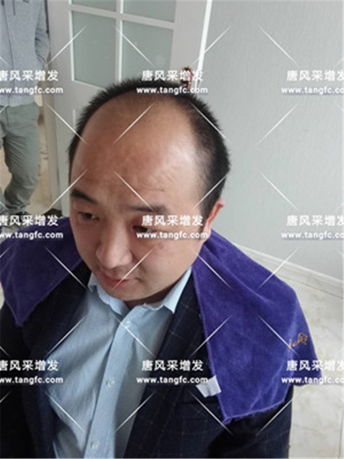 仿真頭皮假發(fā) 80后的小吳客戶(hù)案例