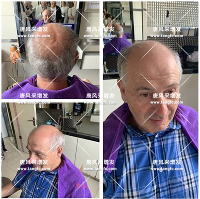 仿真頭皮假發(fā) 唐風(fēng)采客戶(hù)案例
