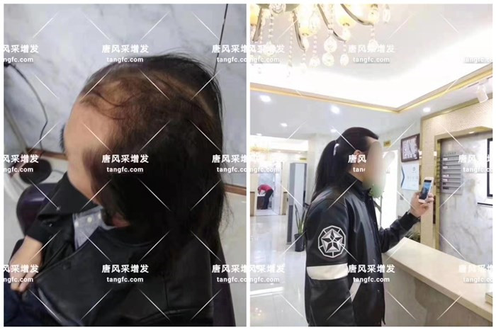 假發(fā)補發(fā)片專賣店 唐風采客戶小Y增發(fā)后