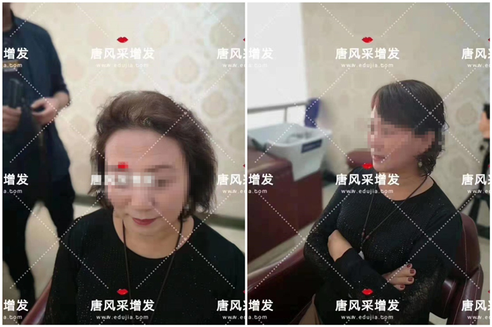中老年頭發(fā)少 唐風采客戶錢阿姨增發(fā)前后對比