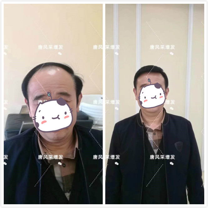 男士真發(fā)假發(fā) 唐風(fēng)采客戶案例