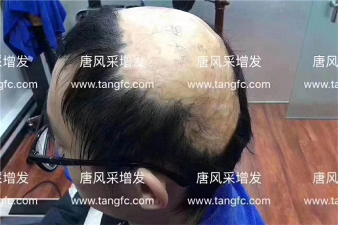 隱形假發(fā)是真的嗎 \