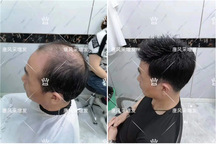隱形假發(fā)是真的嗎 \
