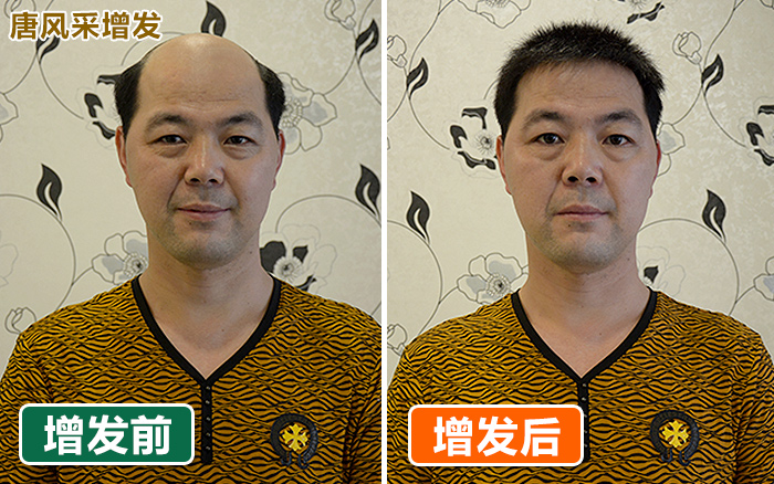 頭發(fā)少戴禿頂假發(fā)片好嗎 \