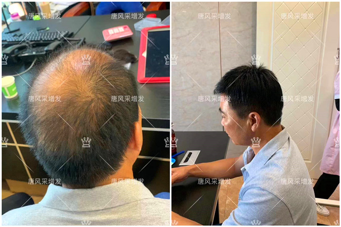 頭頂補(bǔ)發(fā)片買哪種好 \
