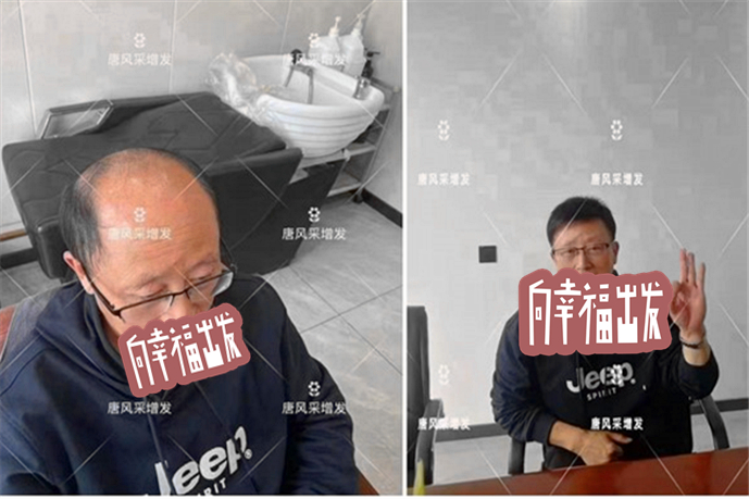 頭頂補(bǔ)發(fā)片買哪種好 \