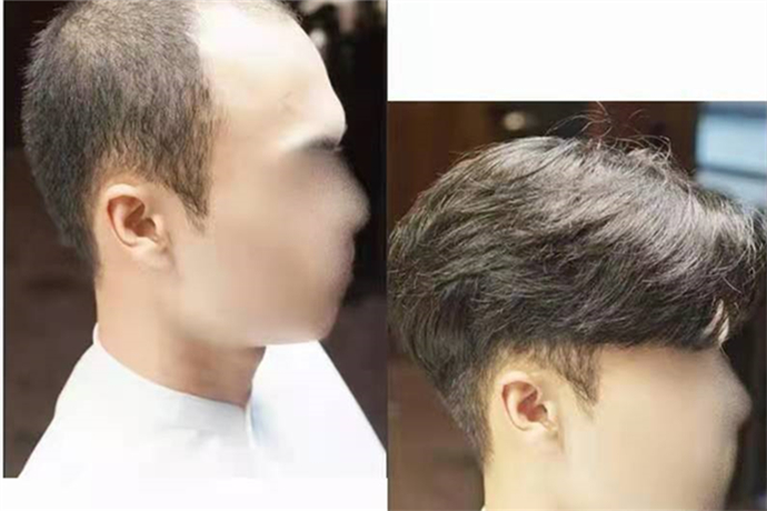 假發(fā)可以戴多久 \