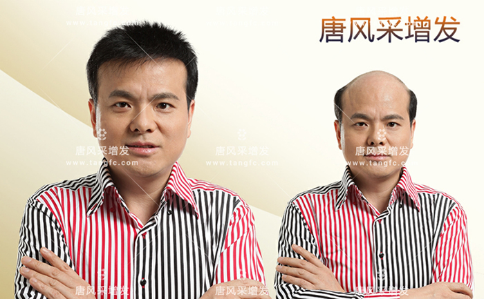 禿頂戴假發(fā)方便嗎 \