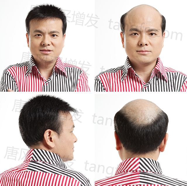 男士頭頂假發(fā)片效果好嗎 \