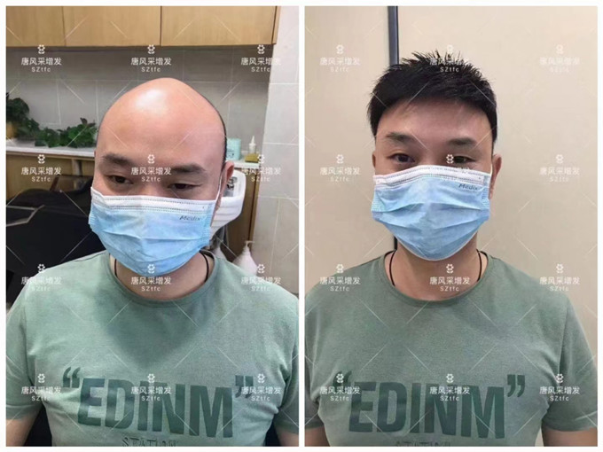 貼在頭頂的假發(fā)塊 \